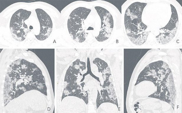 İyileşen koronavirüs hastasının akciğerinde bulundu ürperten sonuç - Resim: 1