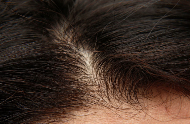 Saçınızdaki kepeklerden kurtulmanın sırları - Resim: 4