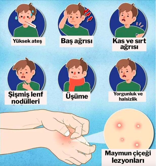 Maymun çiçeği virüsünde toplu taşıma uyarısı! Sosyal mesafe geri döner mi? - Resim: 4