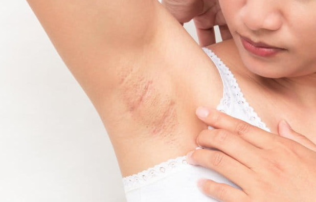 Koltuk altı kararması nedir? Kararmayı gidermek için 3 basit yöntem - Resim: 2