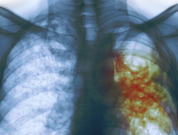 6 ay boyunca öksürük ateş dinmedi akciğerinden prezervatif çıktı! - Resim: 3