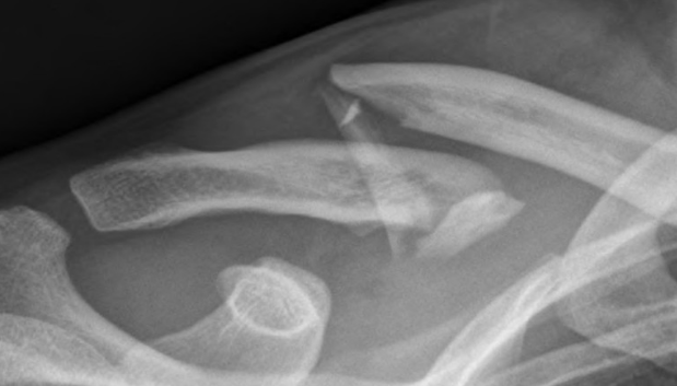 İşte kırıklar hakkında doğru bildiğimiz 5 yanlış! - Resim: 1