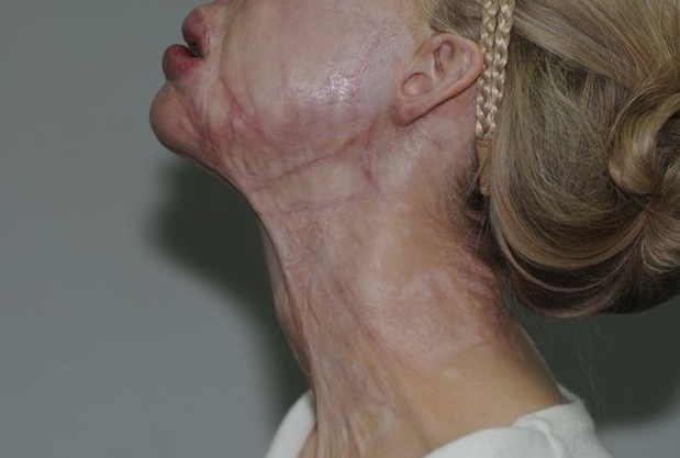 Eski sevgilisi tecavüz edip yüzüne asit fırlattı! Kadın bambaşka biri oldu - Resim: 2