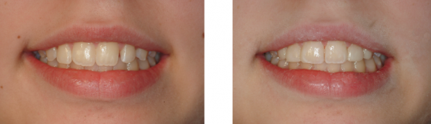 Dişinizin rengi bozulmuş ve yıpranmışsa dikkat! - Resim: 0