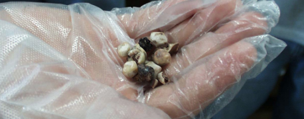 Uzmanından safra kesesi taşı hakkında uyarılar - Resim: 0