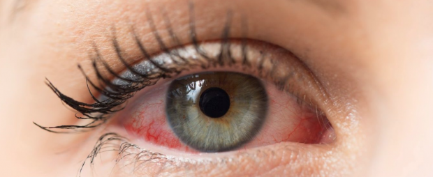 Bahar aylarında ortaya çıkan göz alerjisinin nedeni ve tedavi yöntemleri - Resim: 0