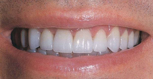 Diş sararmalarını önleyen Block Out yöntemi nedir? - Resim: 3