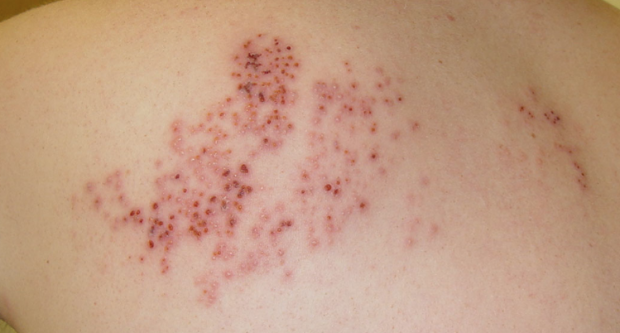 Zona nedir? Kalp krizi ve apandist ile karıştırılıyor - Resim: 0