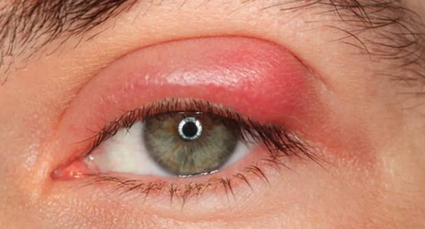 Arpacık neden olur işte doğal yollarla arpacıktan kurtulma yöntemi - Resim: 0