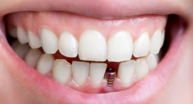 İmplant tedavisi sonrası dikkat edilmesi gerekenler - Resim: 0