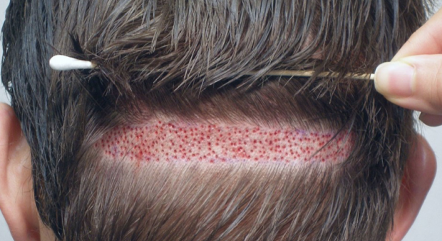 Saç ekimi öncesi nelere dikkat edilmelidir? - Resim: 0