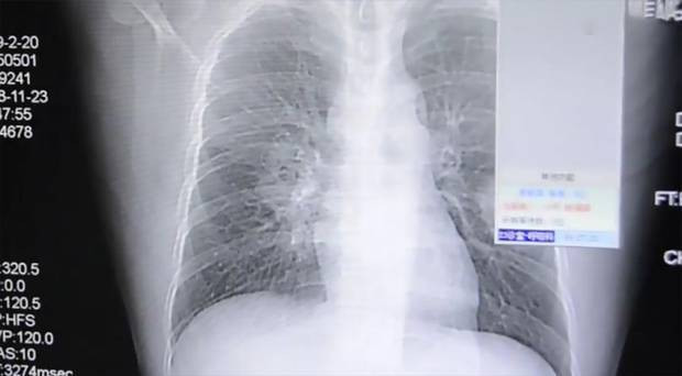 Çorap koklama bağımlısı adamın ciğerleri mantar bağladı - Resim: 1