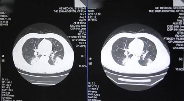 Çorap koklama bağımlısı adamın ciğerleri mantar bağladı - Resim: 3