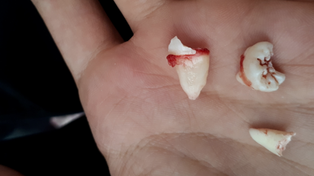 20 yaş dişleri nasıl çekilir ağızdaki en büyük tehlike - Resim: 0