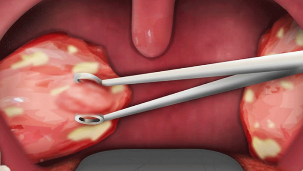 Bu yöntemle bademcik ameliyatındaki ağrılara son! - Resim: 0