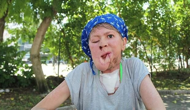 Antalya'da çenesinde çıkan sivilce hayatını kararttı! Meğer bakın neymiş - Resim: 1