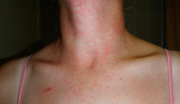 Baharda sık görülen 5 cilt hastalığı! Cildinizde kaşıntı ve kızarıklık varsa... - Resim: 3