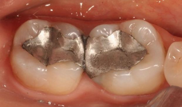 Dişinizin rengi bozulmuş ve yıpranmışsa dikkat! - Resim: 1