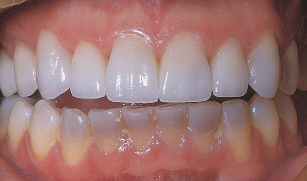 Diş sararmalarını önleyen Block Out yöntemi nedir? - Resim: 0