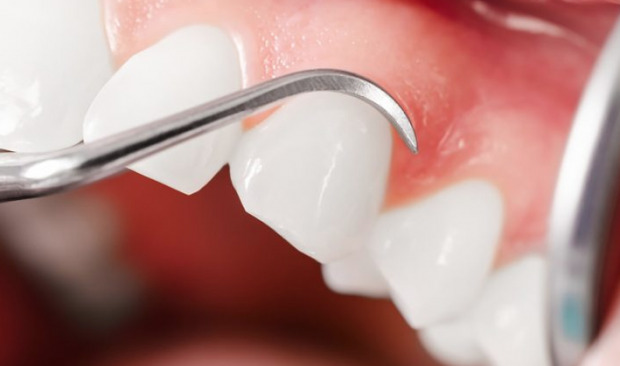 Diş sararmalarını önleyen Block Out yöntemi nedir? - Resim: 1