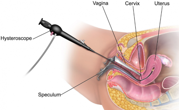 Anne olma şansını artıran yöntem 'histeroskopi' nedir? - Resim: 0