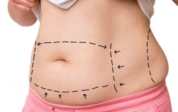 Çikolata kisti nedir işte tehlikeli rahatsızlığın 5 belirtisi - Resim: 0