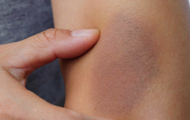 Buerger hastalığı nedir tedavisi var mıdır? - Resim: 0