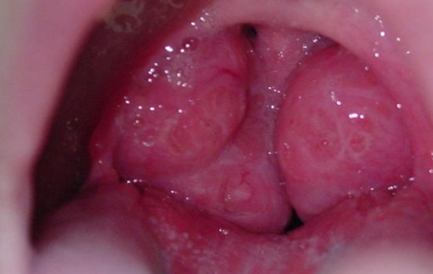 Bu yöntemle bademcik ameliyatındaki ağrılara son! - Resim: 1