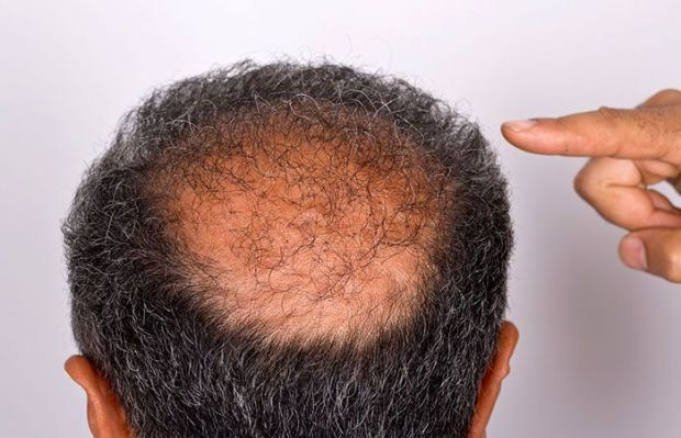 Saç dökülmesi neden olur bazı ilaçlar kel bırakıyor saç kıran da kötü - Resim: 0