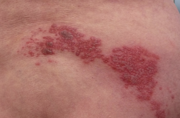 Zona nedir? Kalp krizi ve apandist ile karıştırılıyor - Resim: 1