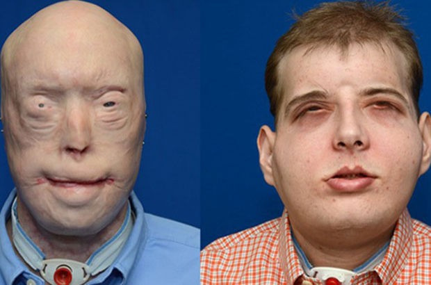 En başarılı yüz nakli yapıldı - Resim: 3