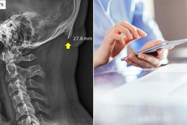 Aşırı cep telefonu kullanımı boynuz çıkıyor! - Resim: 1