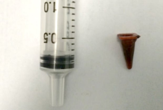 Tıp tarihi bunu da gördü ciğerinden trafik konisi çıktı - Resim: 3