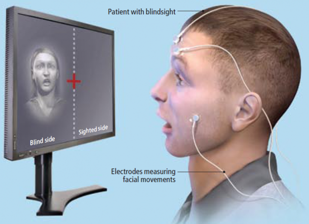 Anton sendromu nedir kör olduğunu farketmeme hastalığı - Resim: 3