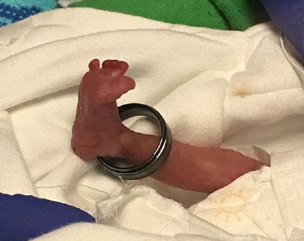 Mucize bebek 1 kilo bile doğmadı ama... - Resim: 1