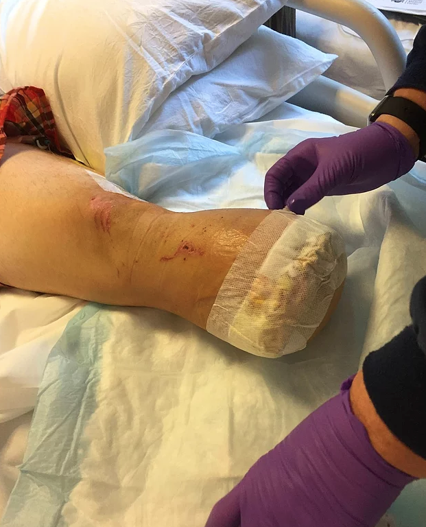 Kazada kopan bacağını pişirip yedi arkadaşlarına ziyafet verdi! - Resim: 2