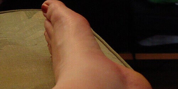 Ayak bileği neden şişer hastalık habercisi midir? - Resim: 0