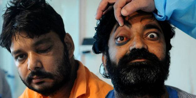 Kara Mantar vakası Türkiye'de görüldü! Bu şikayetlerle hastaneye gitti: Beynine ilerledi - Resim: 1