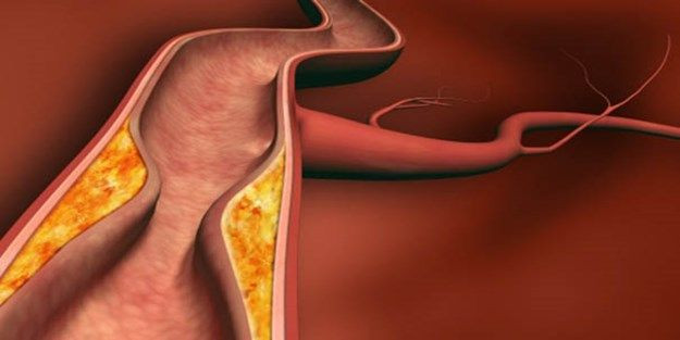 Bu besinler vücuttaki iltihapı yok ediyor! - Resim: 1