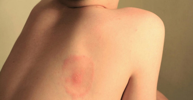 Bu virüs 365 hastalığı taklit edebiliyor! - Resim: 3