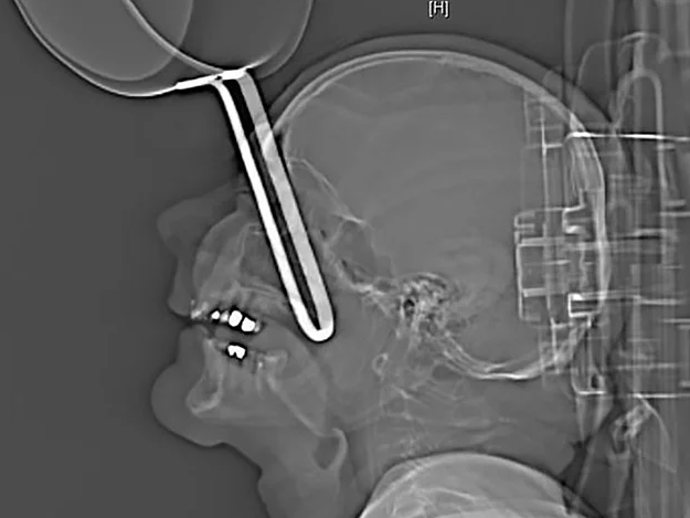 Mutfakta yere düştü gözüne tencere saplandı akıllara zarar olay! - Resim: 1