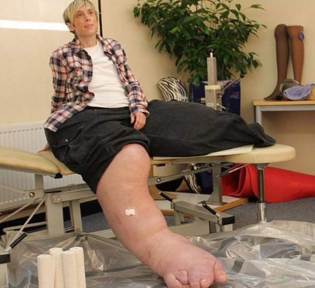 Bu kadının tek bacağı 107 kilo! - Resim: 1