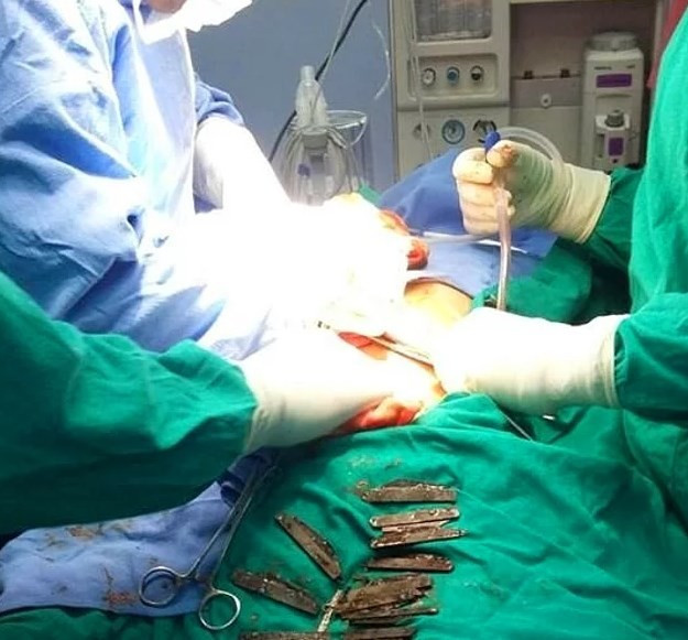 Midesinden 40 adet bıçak çıkartıldı! - Resim: 2