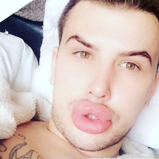 Görenler şaşıp kaldı! Dudakları patlama noktasına geldi - Resim: 2