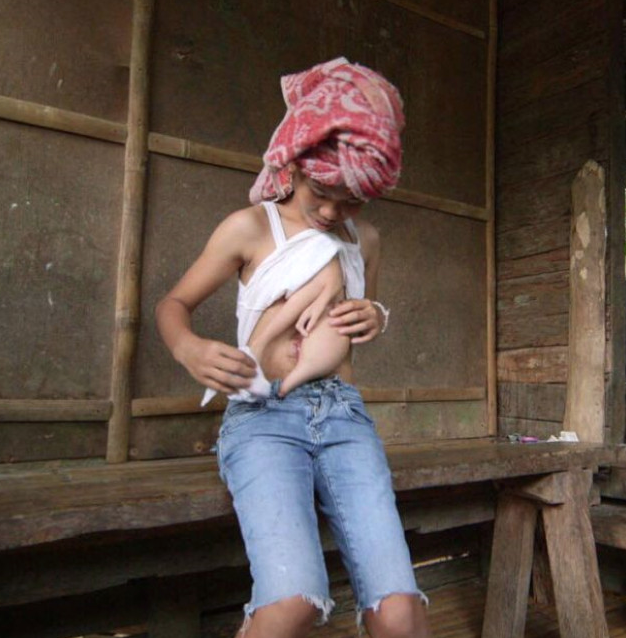 Vücudunda bir vücutla daha doğdu korkup kaçıyorlar! - Resim: 3