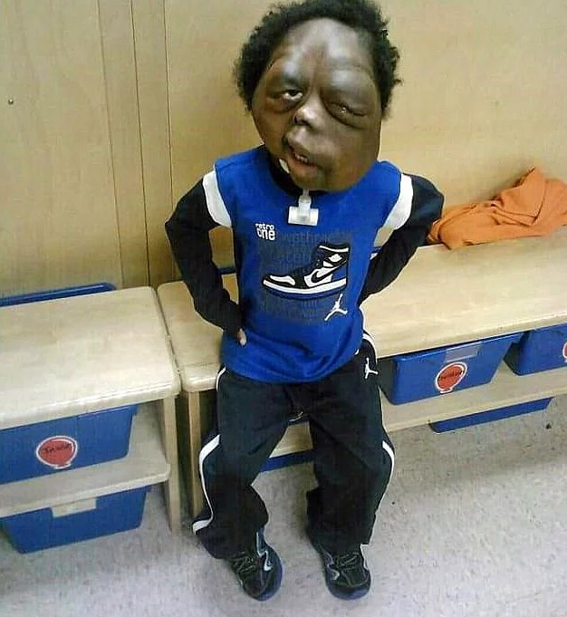 Sadece 8 yaşında ama... Yıllardır tümörle mücadele ediyor - Resim: 1