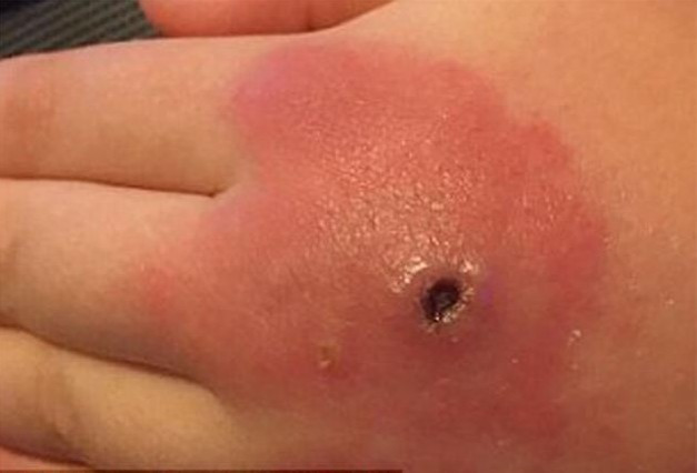 Örümcek ısırığı deyip geçmeyin bu hale getirdi - Resim: 3