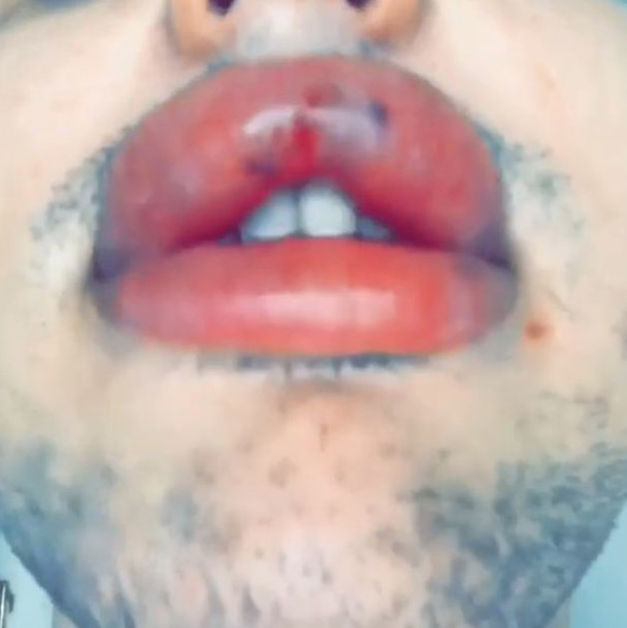 Görenler şaşıp kaldı! Dudakları patlama noktasına geldi - Resim: 3