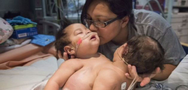 ABD'de yapışık ikizler ameliyatla ayrıldı - Resim: 1