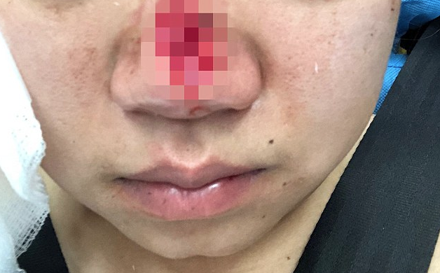 Bardan sonra vahşet! Arkadaşının burnunu ısırdı sonra çiğnedi - Resim: 3